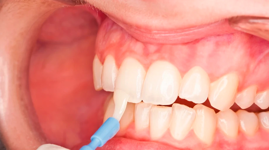 Лак профилактический DMG Flairesse - нанесение